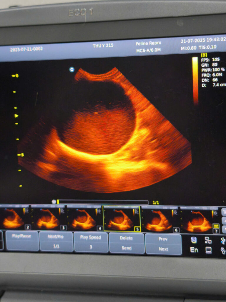 ảnh siêu âm bàng quang chứa nhiều sỏi bùn và máu đông